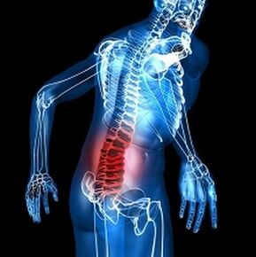 osteohondroze