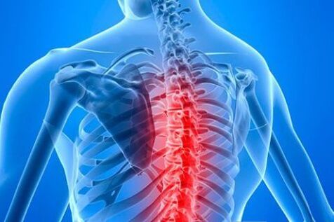 Krūšu kurvja osteohondroze