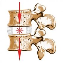 Mugurkaula ierīce un osteohondrozes cēloņi