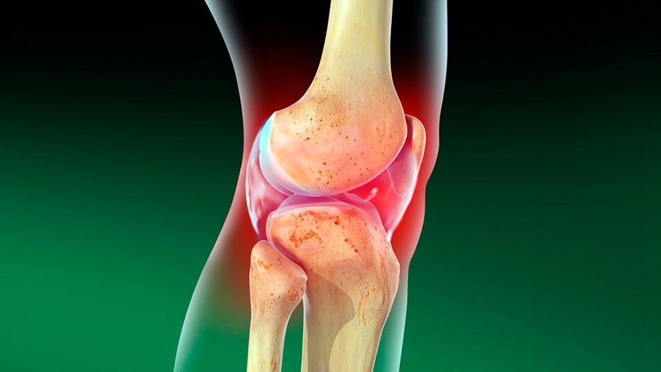 Ceļa locītavas osteoartrīts
